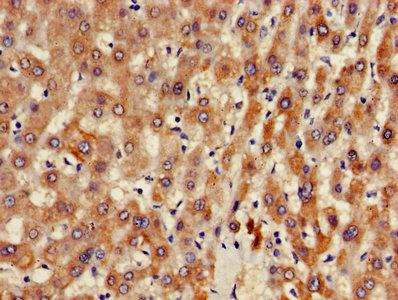 Immunohistochemistry of paraffin-embedded human liver tissue using ARFIP2 Antibody at dilution of 1:100Rabbit anti-Human ARFIP2 Polyclonal Antibody