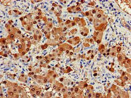 Immunohistochemistry of paraffin-embedded human liver cancer using ARG1 Antibody at dilution of 1:100Rabbit anti-Human ARG1 Polyclonal Antibody