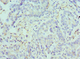 Immunohistochemistry of paraffin-embedded human lung cancer using ARG2 Antibody at dilution of 1:100Rabbit anti-Human ARG2 Polyclonal Antibody