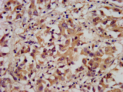 IHC image of ARL1 Antibody diluted at 1:300 and staining in paraffin-embedded human liver cancer performed on a Leica BondTM system. After dewaxing and hydration, antigen retrieval was mediated by high pressure in a citrate buffer (pH 6.0). Section was blocked with 10% normal goat serum 30min at RT. Then primary antibody (1% BSA) was incubated at 4°C overnight. The primary is detected by a biotinylated secondary antibody and visualized using an HRP conjugated SP system.Rabbit anti-Human ARL1 Polyclonal Antibody
