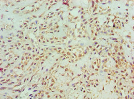 Immunohistochemistry of paraffin-embedded human breast cancer using the antibody at dilution of 1:100