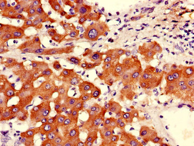 Immunohistochemistry of paraffin-embedded human liver tissue using the antibody at dilution of 1:100Rabbit anti-Human ASGR2 Polyclonal Antibody