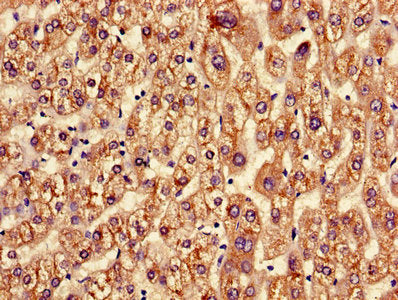 Immunohistochemistry of paraffin-embedded human liver cancer using ASGR2 Antibody at dilution of 1:100Rabbit anti-Human ASGR2 Polyclonal Antibody