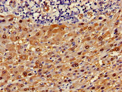 Immunohistochemistry of paraffin-embedded human liver cancer using the antibody at dilution of 1:100Rabbit anti-Human ASL Polyclonal Antibody