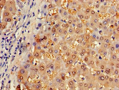 Immunohistochemistry of paraffin-embedded human liver tissue using ASL Antibody at dilution of 1:100Rabbit anti-Human ASL Polyclonal Antibody