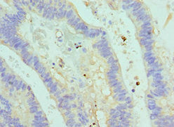 Immunohistochemistry of paraffin-embedded human colon cancer using ASMTL Antibody at dilution of 1:100Rabbit anti-Human ASMTL Polyclonal Antibody