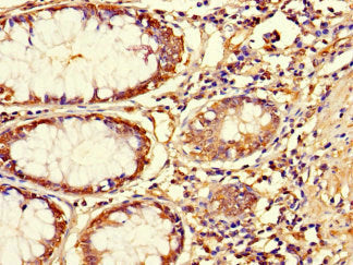 Immunohistochemistry of paraffin-embedded human colon cancer using ASPN Antibody at dilution of 1:100Rabbit anti-Human ASPN Polyclonal Antibody