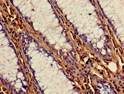 Immunohistochemistry of paraffin-embedded human colon cancer using the antibody at dilution of 1:100Rabbit anti-Human CSTB Polyclonal Antibody