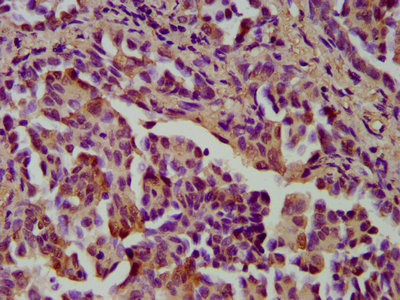 IHC image of CSTB Antibody diluted at 1:400 and staining in paraffin-embedded human lung cancer performed on a Leica BondTM system. After dewaxing and hydration, antigen retrieval was mediated by high pressure in a citrate buffer (pH 6.0). Section was blocked with 10% normal goat serum 30min at RT. Then primary antibody (1% BSA) was incubated at 4°C overnight. The primary is detected by a biotinylated secondary antibody and visualized using an HRP conjugated SP system.Rabbit anti-Human CSTB Polyclonal Antibody