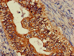 Immunohistochemistry of paraffin-embedded human colon cancer using ASTN2 Antibody at dilution of 1:100