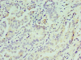 Immunohistochemistry of paraffin-embedded human lung cancer using ATF7 Antibody at dilution of 1:100Rabbit anti-Human ATF7 Polyclonal Antibody