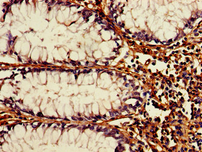 IHC image of ATG3 Antibody diluted at 1:1200 and staining in paraffin-embedded human colon cancer performed on a Leica BondTM system. After dewaxing and hydration, antigen retrieval was mediated by high pressure in a citrate buffer (pH 6.0). Section was blocked with 10% normal goat serum 30min at RT. Then primary antibody (1% BSA) was incubated at 4°C overnight. The primary is detected by a biotinylated secondary antibody and visualized using an HRP conjugated SP system.Rabbit anti-Human ATG3 Polyclonal Antibody