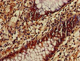Immunohistochemistry of paraffin-embedded human colon cancer using ATG4B Antibody at dilution of 1:100