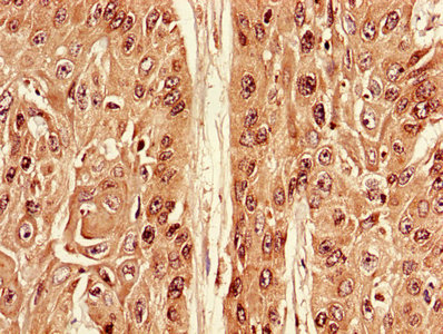 Immunohistochemistry of paraffin-embedded human cervical cancer using the antibody at dilution of 1:100