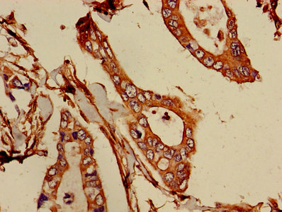 Immunohistochemistry of paraffin-embedded human pancreatic cancer using ATIC Antibody at dilution of 1:100