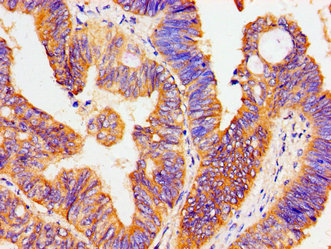 Immunohistochemistry of paraffin-embedded human colon cancer using ATP1B1 Antibody at dilution of 1:100