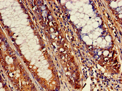 Immunohistochemistry of paraffin-embedded human colon cancer using the antibody at dilution of 1:100
