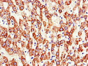 Immunohistochemistry of paraffin-embedded human liver cancer using ATP5F1A Antibody at dilution of 1:100