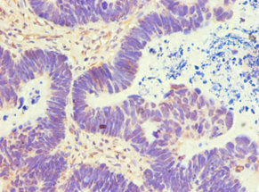 Immunohistochemistry of paraffin-embedded human ovarian cancer using ATP5B Antibody at dilution of 1:100
