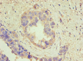 Immunohistochemistry of paraffin-embedded human endometrial cancer using ATP5B Antibody at dilution of 1:100
