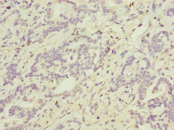 Immunohistochemistry of paraffin-embedded human lung cancer using ATP5F1D Antibody at dilution of 1:100Rabbit anti-Human ATP5D Polyclonal Antibody
