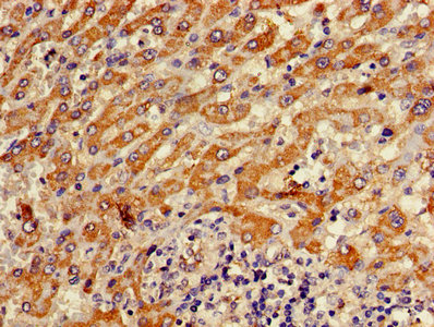 Immunohistochemistry of paraffin-embedded human liver cancer using the antibody at dilution of 1:100