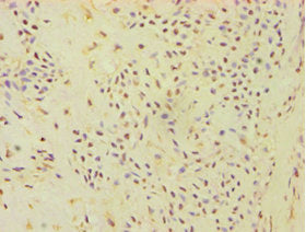 Immunohistochemistry of paraffin-embedded human breast cancer using ATP5J Antibody at dilution of 1:100