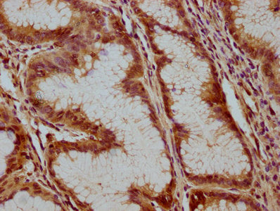 IHC image of the antibody diluted at 1:100 and staining in paraffin-embedded human gastric cancer performed on a Leica BondTM system. After dewaxing and hydration, antigen retrieval was mediated by high pressure in a citrate buffer (pH 6.0). Section was blocked with 10% normal goat serum 30min at RT. Then primary antibody (1% BSA) was incubated at 4°C overnight. The primary is detected by a biotinylated secondary antibody and visualized using an HRP conjugated SP system.