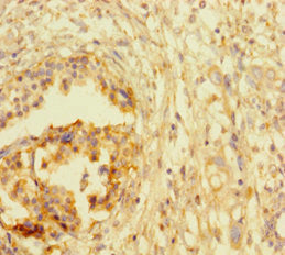 Immunohistochemistry of paraffin-embedded human pancreatic cancer using ATRX Antibody at dilution of 1:100