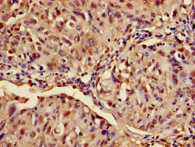 Immunohistochemistry of paraffin-embedded human lung cancer using ATXN3 Antibody at dilution of 1:100