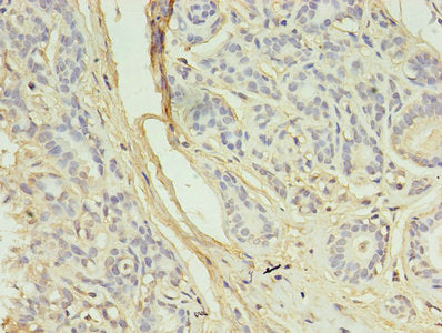 Immunohistochemistry of paraffin-embedded human breast cancer using AURKB Antibody at dilution of 1:100