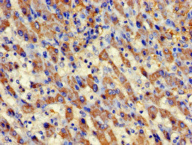 Immunohistochemistry of paraffin-embedded human liver cancer using AURKC Antibody at dilution of 1:100