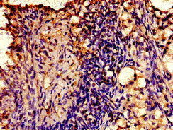 Immunohistochemistry of paraffin-embedded human ovarian cancer using AVPR2 Antibody at dilution of 1:100