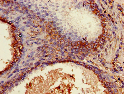 Immunohistochemistry of paraffin-embedded human prostate cancer using B2M Antibody at dilution of 1:100Rabbit anti-Human B2M Polyclonal Antibody