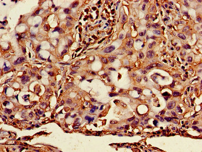 Immunohistochemistry of paraffin-embedded human lung cancer using B2M Antibody at dilution of 1:100Rabbit anti-Human B2M Polyclonal Antibody