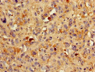 Immunohistochemistry of paraffin-embedded human melanoma using BACE1 Antibody at dilution of 1:100