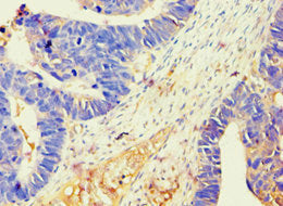Immunohistochemistry of paraffin-embedded human ovarian cancer using BAG2 Antibody at dilution of 1:100