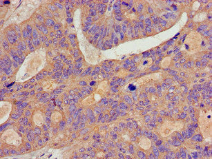 Immunohistochemistry of paraffin-embedded human colon cancer using BCAR1 Antibody at dilution of 1:100