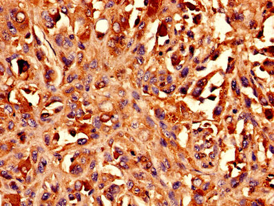 Immunohistochemistry analysis of human melanoma using the antibody at dilution of 1:100