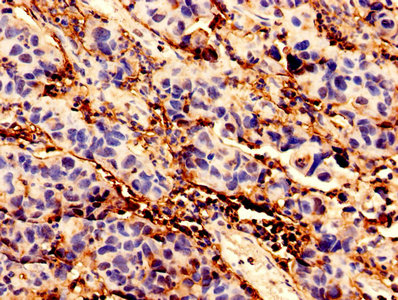 Immunohistochemistry analysis of human bladder cancer using BCAT1 Antibody at dilution of 1:100