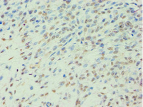 Immunohistochemistry of paraffin-embedded human breast cancer using BCKDK Antibody at dilution of 1:100