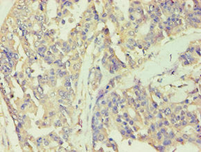 Immunohistochemistry of paraffin-embedded human endometrial cancer using BCKDK Antibody at dilution of 1:100