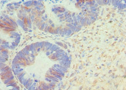 Immunohistochemistry of paraffin-embedded human ovarian cancer using BCL10 Antibody at dilution of 1:100