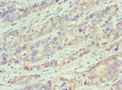 Immunohistochemistry of paraffin-embedded human endometrial cancer using BCL10 Antibody at dilution of 1:100
