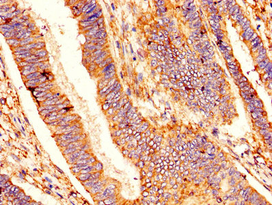 IHC image of BCL2L1 Antibody diluted at 1:400 and staining in paraffin-embedded human colon cancer performed on a Leica BondTM system. After dewaxing and hydration, antigen retrieval was mediated by high pressure in a citrate buffer (pH 6.0). Section was blocked with 10% normal goat serum 30min at RT. Then primary antibody (1% BSA) was incubated at 4°C overnight. The primary is detected by a biotinylated secondary antibody and visualized using an HRP conjugated SP system.