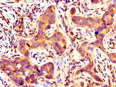 IHC image of BCL2L1 Antibody diluted at 1:400 and staining in paraffin-embedded human pancreatic cancer performed on a Leica BondTM system. After dewaxing and hydration, antigen retrieval was mediated by high pressure in a citrate buffer (pH 6.0). Section was blocked with 10% normal goat serum 30min at RT. Then primary antibody (1% BSA) was incubated at 4°C overnight. The primary is detected by a biotinylated secondary antibody and visualized using an HRP conjugated SP system.