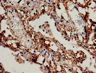 Immunocytochemistry analysis of human lung cancer using BCL2L11 Antibody at dilution of 1:100