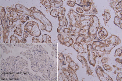 IHC image of BCL3 Antibody diluted at 1:100 and staining in paraffin-embedded human breast cancer performed on a Leica BondTM system. After dewaxing and hydration, antigen retrieval was mediated by high pressure in a citrate buffer (pH 6.0). Section was blocked with 10% normal goat serum 30min at RT. Then primary antibody (1% BSA) was incubated at 4°C overnight. The primary is detected by a biotinylated secondary antibody and visualized using an HRP conjugated SP system.