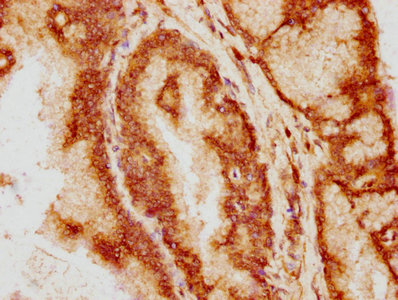 IHC image of BCL9 Antibody diluted at 1:200 and staining in paraffin-embedded human prostate tissue performed on a Leica BondTM system. After dewaxing and hydration, antigen retrieval was mediated by high pressure in a citrate buffer (pH 6.0). Section was blocked with 10% normal goat serum 30min at RT. Then primary antibody (1% BSA) was incubated at 4°C overnight. The primary is detected by a biotinylated secondary antibody and visualized using an HRP conjugated SP system.