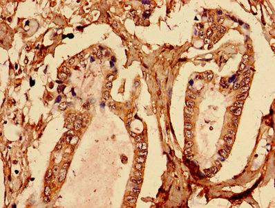 Immunohistochemistry analysis of human pancreatic cancer using the antibody at dilution of 1:100